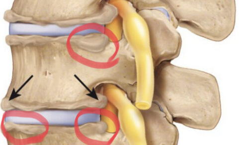 Kaj je spondiloza: osteoartroza, osteohondroza ali degenerativna bolezen diskov