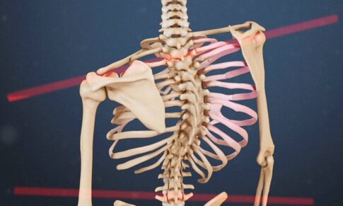 Skolioza in kako narediti uspeh: So vaje za skoliozo dejansko koristne?
